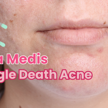 Jerawat di Segitiga Berbahaya Wajah, Fakta Medis yang Perlu Kamu Ketahui