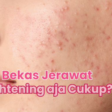 Hilangin Bekas Jerawat, Apakah Cukup dengan Brightening Aja?