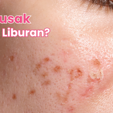 Kenapa Kulit Sering “Rusak” Setelah Liburan, Padahal Tidak Ganti Produk?